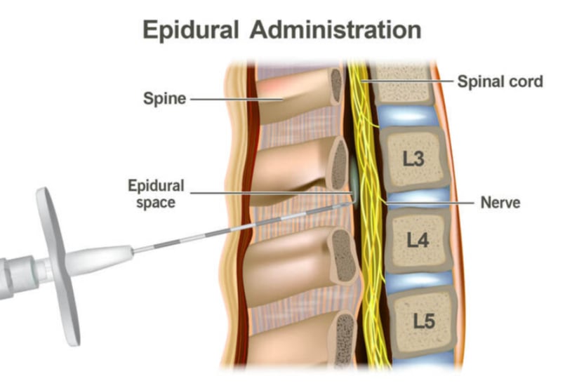 Epidural Nedir Prosed r Riskleri Ve Yan Etkileri Nelerdir Evrim A ac epidural-nedir-prosed-r-riskleri-ve-yan-etkileri-nelerdir-evrim-a-ac